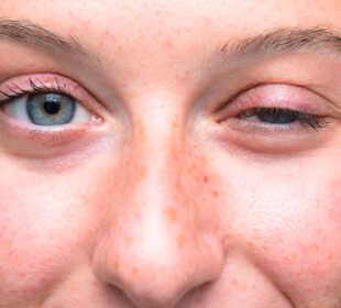 Understanding Eye Muscle Weakness Causes, Symptoms, And Treatment