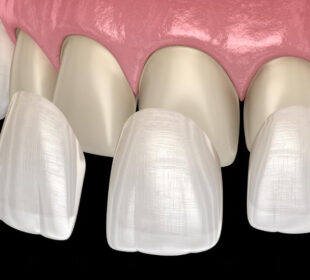 What Are Porcelain Dental Veneers in Cosmetic Dentistry