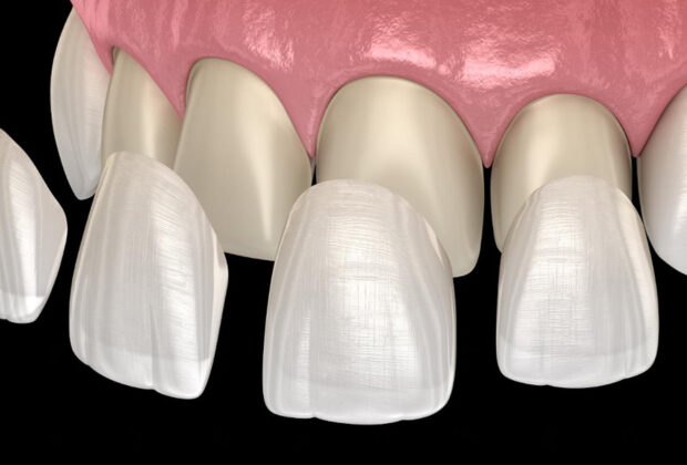 What Are Porcelain Dental Veneers in Cosmetic Dentistry