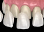 What Are Porcelain Dental Veneers in Cosmetic Dentistry