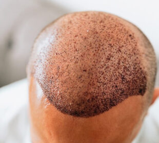 Common Mistakes That Most Hair Transplant Patients Do