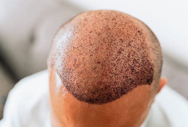 Common Mistakes That Most Hair Transplant Patients Do