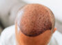 Common Mistakes That Most Hair Transplant Patients Do