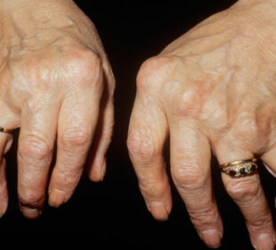 Arthritis Awareness How to Improve Quality of Life with Arthritis