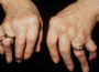 Arthritis Awareness How to Improve Quality of Life with Arthritis
