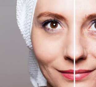 Reveal a Smoother Youthful Look with the Power of Laser Wrinkle Removal