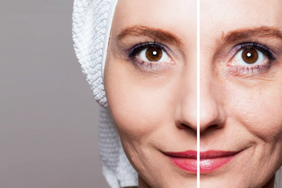 Reveal a Smoother Youthful Look with the Power of Laser Wrinkle Removal