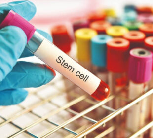 Post Treatment Care Recovery and Lifestyle Tips from StemCellCure Experts