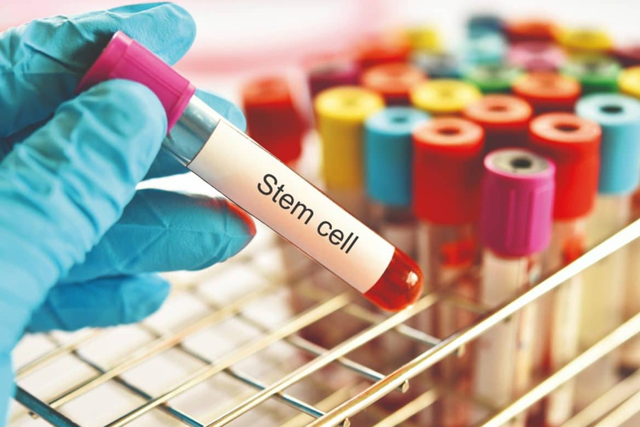 Post Treatment Care Recovery and Lifestyle Tips from StemCellCure Experts