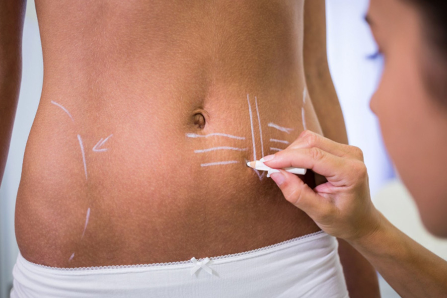 7 Questions People Forget To Ask Before Choosing Stomach Fat Removal