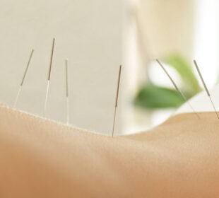 Comparing TCM Acupuncture vs Western Dry Needling