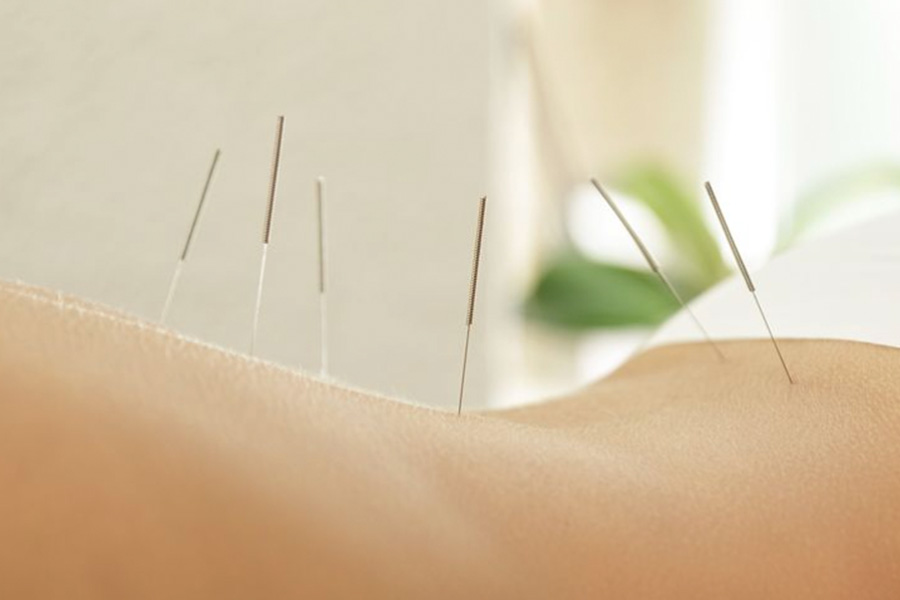 Comparing TCM Acupuncture vs Western Dry Needling