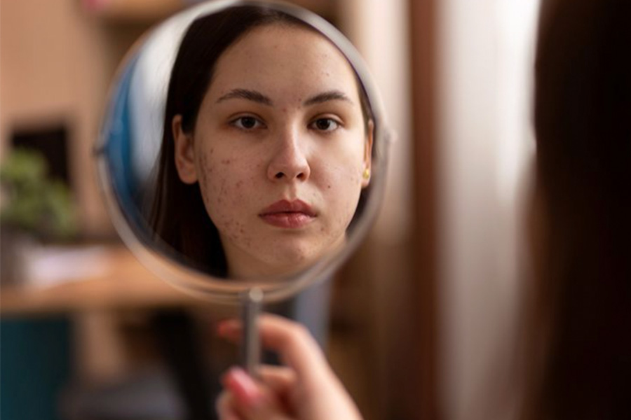 Why Acne Marks Persist and How an Aesthetic Clinic in Singapore Can Address Them