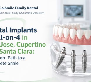Dental Implants and All on 4 in San Jose Cupertino and Santa Clara A Modern Path to a Complete Smile