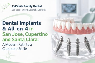 Dental Implants and All on 4 in San Jose Cupertino and Santa Clara A Modern Path to a Complete Smile