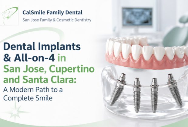 Dental Implants and All on 4 in San Jose Cupertino and Santa Clara A Modern Path to a Complete Smile